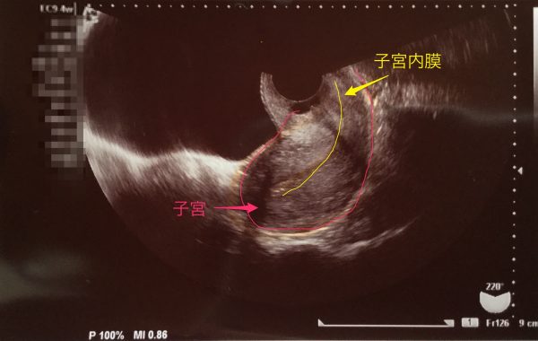 子宮超音波検査画像